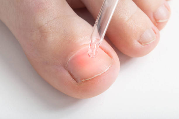 applying medicated oil to the toenail to strengthen the nail plate and age the nail fungus, macro - medicated imagens e fotografias de stock