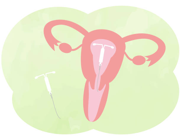 This is an illustration of an IUD (intrauterine device). This is an illustration of an IUD (intrauterine device). fertilized egg stock illustrations