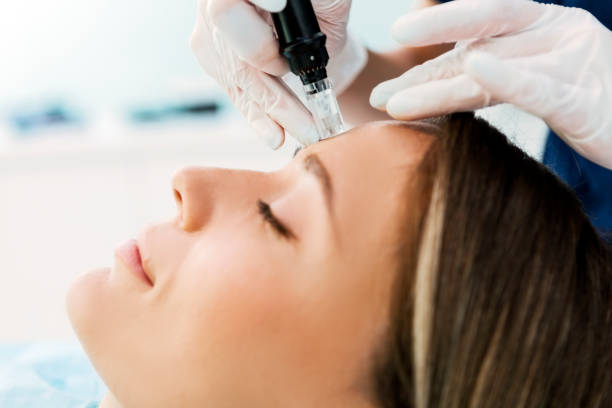 istock Dermapen skin needling treatment on a patient forehead skin 1301266517