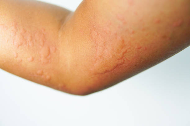 istock Close up Allergy Rash on sensitive skin 1301307079