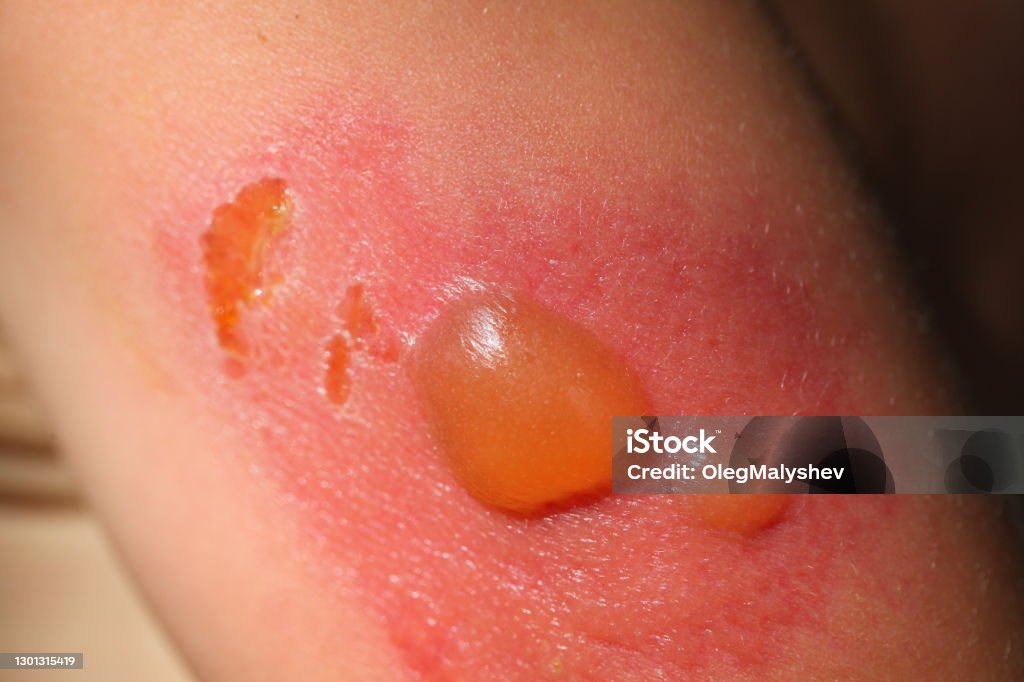 Second-degree sunburn on the skin of a child in the blisters￼ painful blisters from sunburn on a child's body Burning Stock Photo