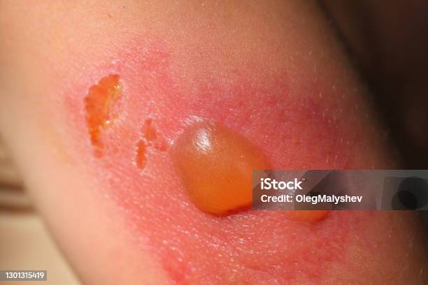 Seconddegree Sunburn On The Skin Of A Child In The Blisters Stock Photo - Download Image Now