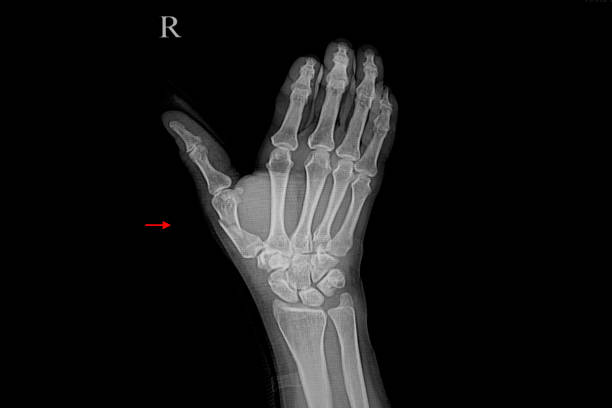 xray ręki pacjenta wykazujące złamania kości. - metacarpal zdjęcia i obrazy z banku zdjęć