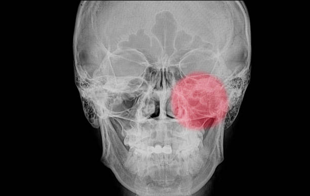 película de rayos x de un cráneo de un sinusal paranasal paciente - acute mountain sickness fotografías e imágenes de stock