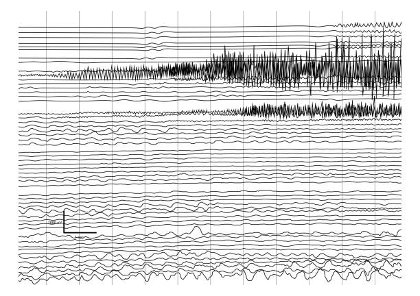 illustrazioni stock, clip art, cartoni animati e icone di tendenza di illustrazione vettoriale della registrazione ictal eeg durante il sequestro. - eeg epilepsy science electrode