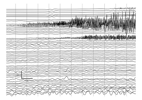 Vector Illustration of ictal EEG recording during seizure. Seizure waves showing propagation of high amplitudes and frequency waves.