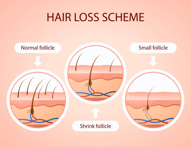 Gradient Hair Loss Scheme Vector Illustration Stock Illustration - Download  Image Now - Hair Loss, Alopecia, Diagram - iStock