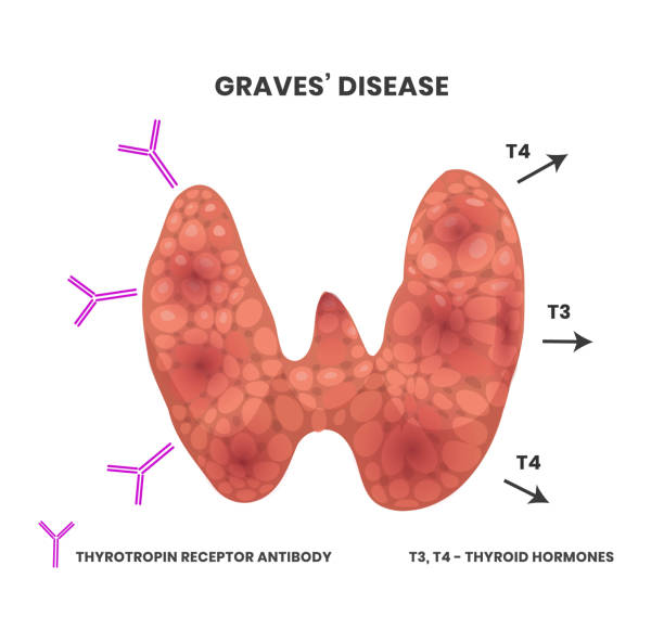 180+ Graves' Disease Stock Photos, Pictures & Royalty-Free Images - iStock