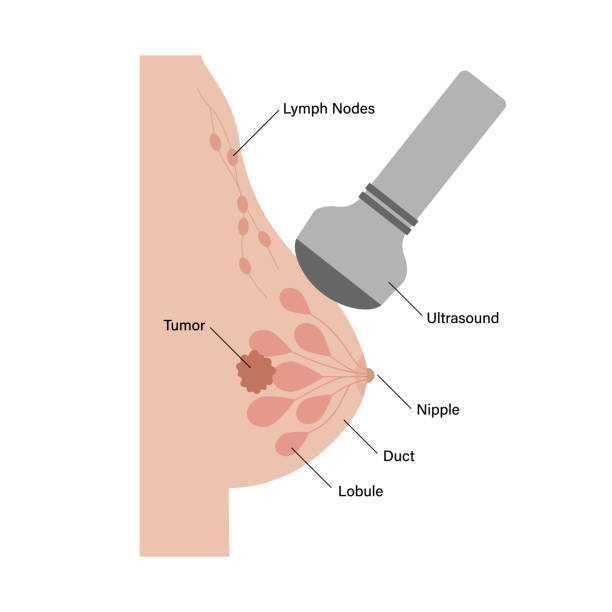 ilustrações de stock, clip art, desenhos animados e ícones de breast disease concept - adipose cell