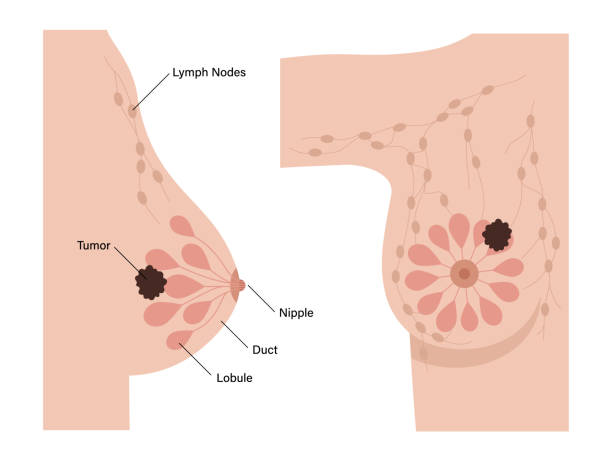 illustrazioni stock, clip art, cartoni animati e icone di tendenza di concetto di malattia mammario - areola