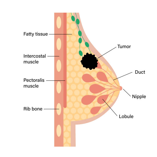 ilustrações de stock, clip art, desenhos animados e ícones de breast disease concept - cancer cell cancer breast cancer breast