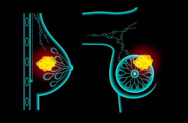 ilustrações de stock, clip art, desenhos animados e ícones de breast disease concept - pain rib cage x ray image chest