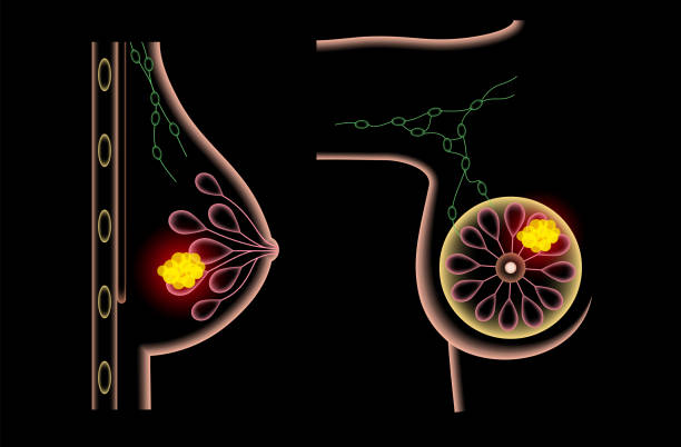ilustrações de stock, clip art, desenhos animados e ícones de breast disease concept - pain rib cage x ray image chest