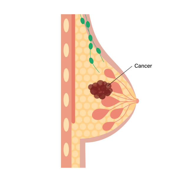 ilustrações de stock, clip art, desenhos animados e ícones de breast disease concept - adipose cell