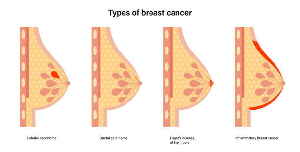 ilustrações de stock, clip art, desenhos animados e ícones de breast disease concept - adipose cell