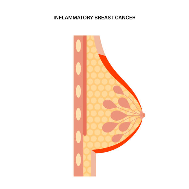 ilustrações de stock, clip art, desenhos animados e ícones de breast disease concept - cancer cell cancer breast cancer breast