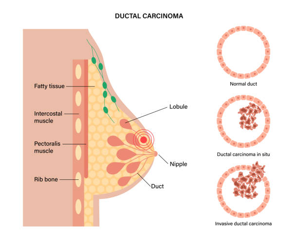 ilustrações de stock, clip art, desenhos animados e ícones de breast disease concept - cancer cell cancer breast cancer breast