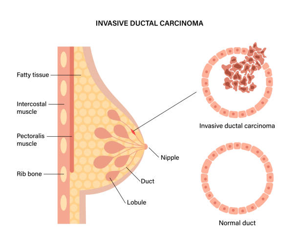 ilustrações de stock, clip art, desenhos animados e ícones de breast disease concept - cancer cell cancer breast cancer breast