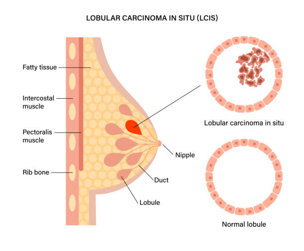 ilustrações de stock, clip art, desenhos animados e ícones de breast disease concept - adipose cell