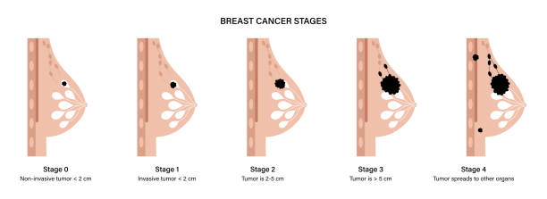 ilustrações de stock, clip art, desenhos animados e ícones de breast disease concept - adipose cell