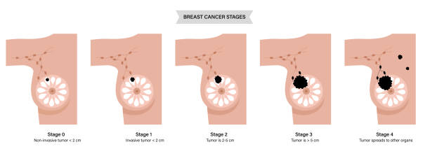 ilustrações de stock, clip art, desenhos animados e ícones de breast disease concept - areola