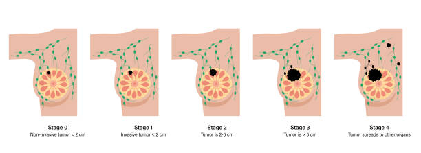 illustrazioni stock, clip art, cartoni animati e icone di tendenza di concetto di malattia mammario - areola