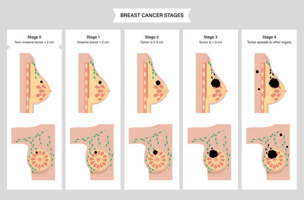ilustrações de stock, clip art, desenhos animados e ícones de breast disease concept - cancer cell cancer breast cancer breast