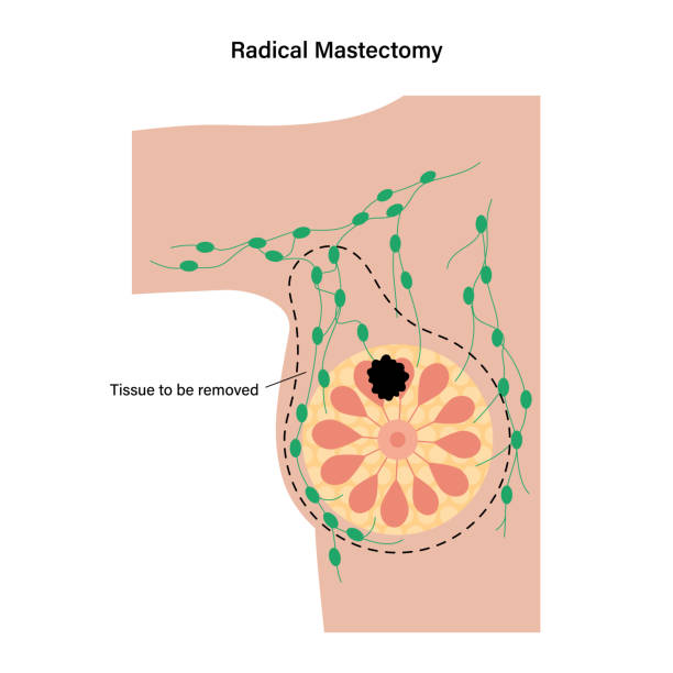 ilustrações de stock, clip art, desenhos animados e ícones de breast disease concept - cancer cell cancer breast cancer breast