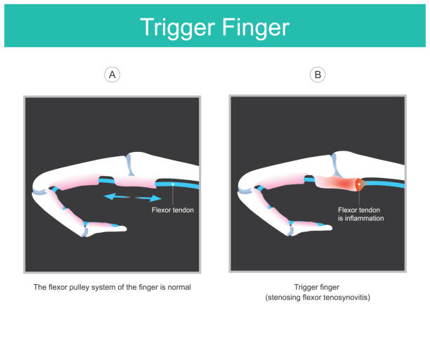 ilustrações de stock, clip art, desenhos animados e ícones de trigger finger. illustration explain a symptom of locked finger caused by a problem with the tendon of human finger which can not inability to move fingers. illustration."n - finger on the trigger