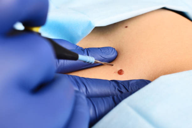 dermatologist surgeon removes a neoplasm - a mole or nevus from the patient's abdomen with a radio wave knife. stock photo