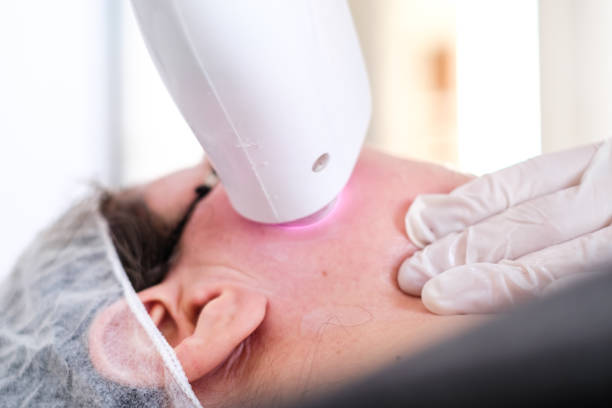 kosmetikerin gibt epilation laser behandlung auf das gesicht der frau - haarentfernung durch elektrolyse stock-fotos und bilder