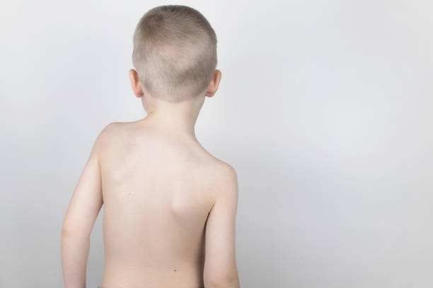 a little boy at the doctor's appointment with back pain. treatment of spinal deformity and stoop. osteoporosis, kyphosis, lordosis, or scoliosis. - front stoop imagens e fotografias de stock