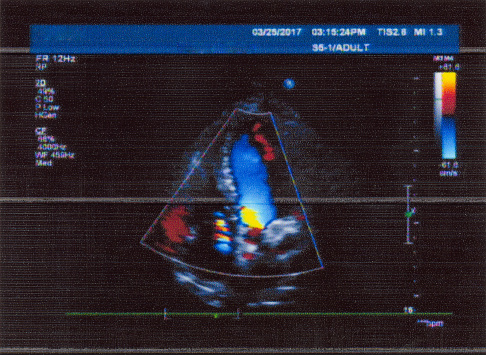 Heart Color Ultrasound Medical Examination Image