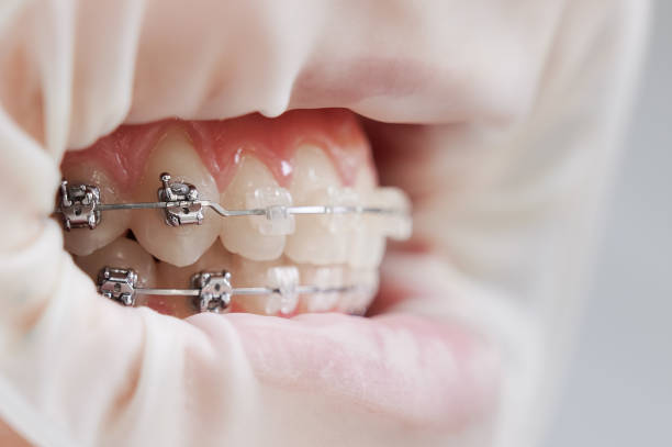 Metal and ceramic braces on white teeth and cheek retractor. Concept of dental care - https://media.istockphoto.com/id/1302449203/photo/macro-photography-of-humans-mouth-with-metal-braces-and-cheek-retractor.jpg?s=612x612&w=0&k=20&c=LB0ze52-TEF_OMpAsIitAqPrEih3jyWtbcQcfppegV4=