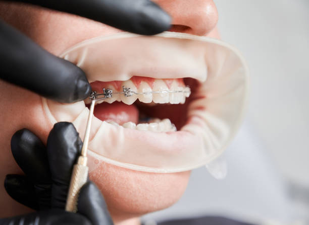 istock Orthodontist placing braces on female patient teeth. 1302449213