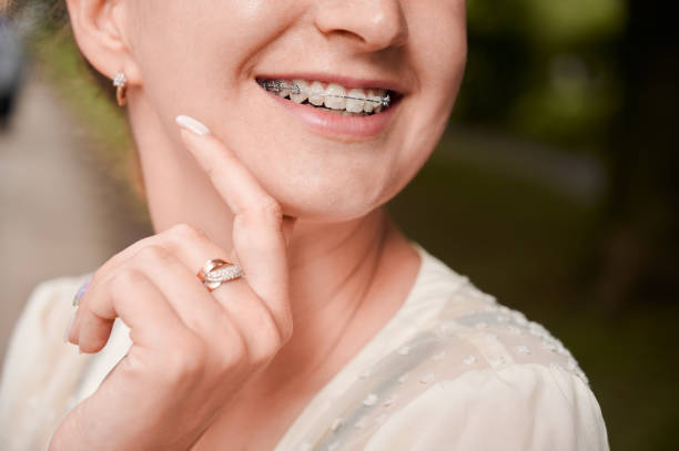 istock Female smile with orthodontic braces on teeth. 1302461073