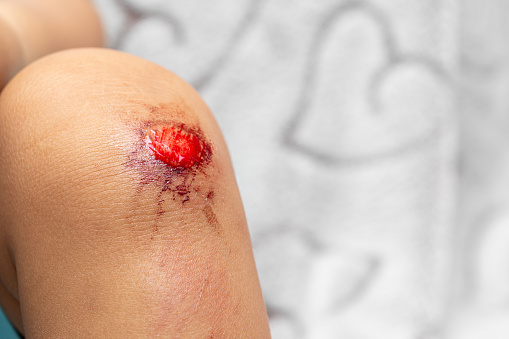 Closeup of a baby knee with abrasion, concept of infant dangers and hygiene to avoid infection, copy space