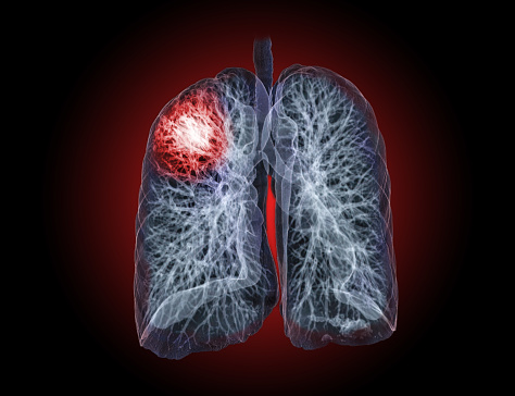 CT Chest or Lung 3D rendering image  for diagnosis TB,tuberculosis and covid-19 .