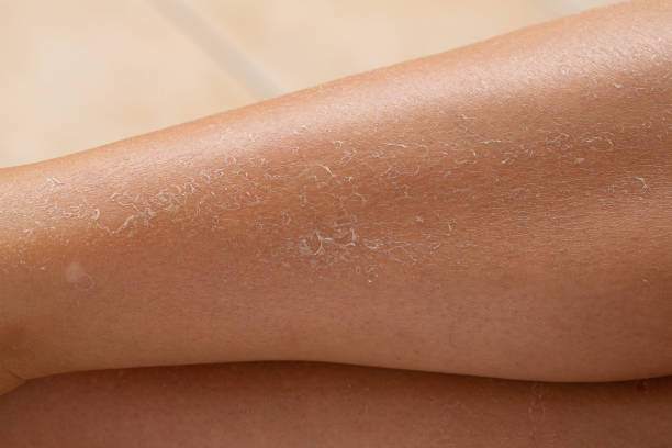 close-up of female legs with peeling dry skin Detail of dry skin of woman legs. Dehydration due to the sun's rays without sun protection cream dry stock pictures, royalty-free photos & images