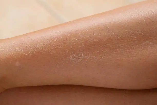 Detail of dry skin of woman legs. Dehydration due to the sun's rays without sun protection cream