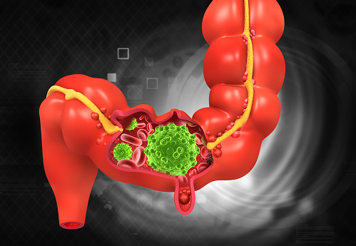 Colon cancer, bacteria's, viruses in sick unhealthy intestine. 3d illustration