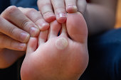 Children's foot with problem areas on the skin, dry corn. Plantar wart of the foot. Unhealthy foot skin concept