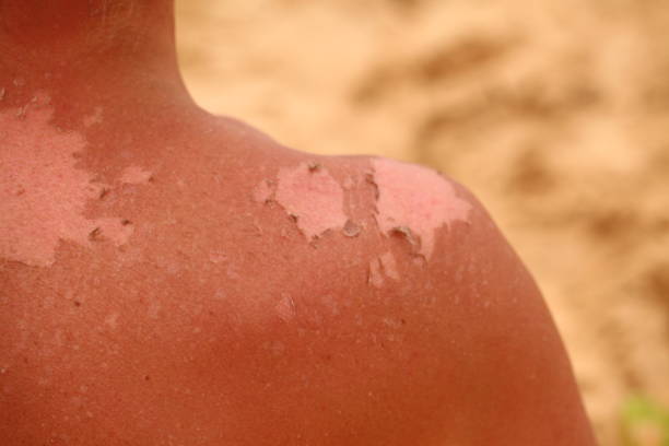 istock sunburn skin  on the back of a man 1302745190