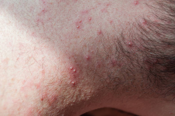 éruptions purulentes sur le cou d’un homme. allergie, acné. maladies de la peau - pathogen streptococcus life science photos et images de collection