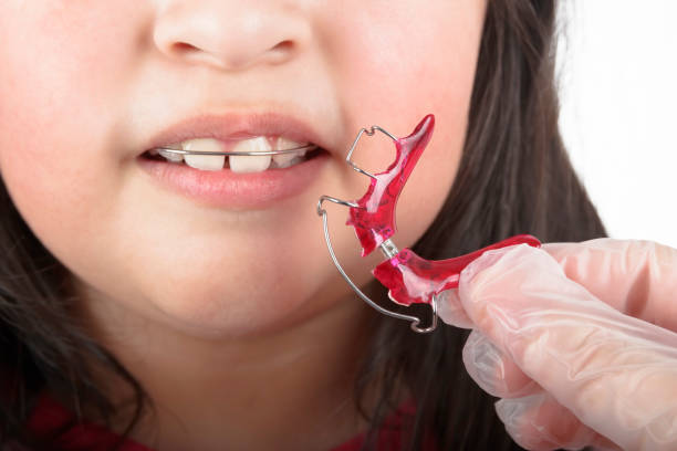 A dentist with gloves on his hands places orthodontic appliances on a girl's teeth to correct them stock photo