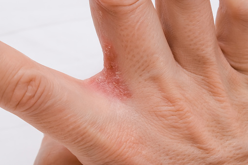 Hand with interdigital dermatitis, dyshidrotic eczema on hand close up.