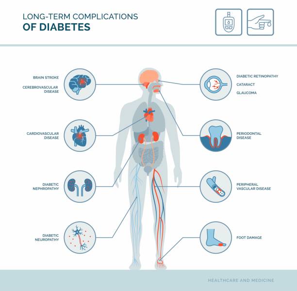 Long-term complications of diabetes Long-term complications of diabetes medical infographic: diabetes effects on the body condition illustrations stock illustrations