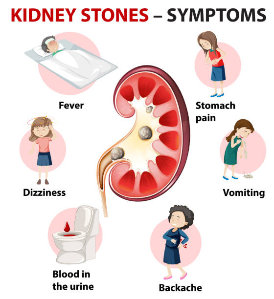 ilustraciones, imágenes clip art, dibujos animados e iconos de stock de síntomas de cálculos renales síntomas infografía estilo dibujos animados - kidney stone