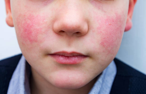 8 years old child with red cheeks- enterovirus infection, diathesis or allergy symptoms. Redness and peeling of the skin on the face. stock photo