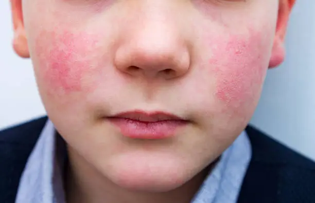 Photo of 8 years old child with red cheeks- enterovirus infection, diathesis or allergy symptoms. Redness and peeling of the skin on the face.